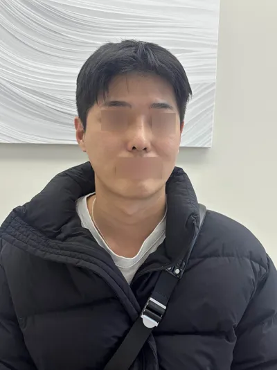 男性の鼻の再手術レビュー！！