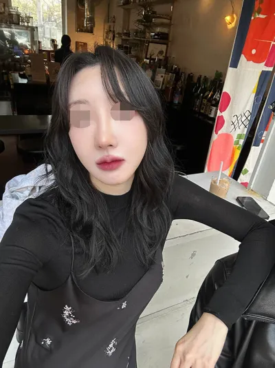 キム・ヒョンウ院長に鼻の再手術（自家肋軟骨）を受けたレポです。