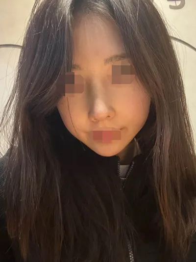 ウォントで自家肋軟骨の鼻整形を受けました！