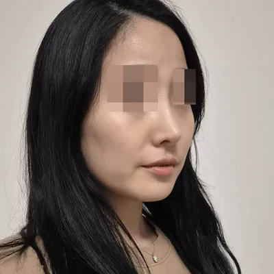 初めての鼻整形、WANT（ウォント）で受けました！（術後5ヶ月目）