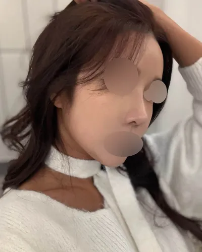 低くて曲がった鼻を改善したくて、再手術を受けることになりました。