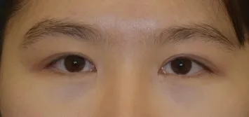 ついに非切開目つき矯正で手術しましたぁｗｗｗｗｗ