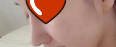 スヌンが終わって友達と一緒に鼻の整形をしたんだけど