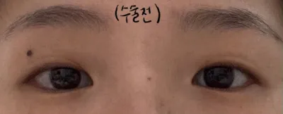 埋没+目頭切開レビュー