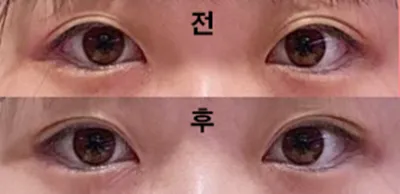 埋没で手術しました！