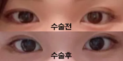 二重再手術3ヶ月目です!