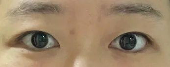 切開二重と目頭切開 5ヶ月目のレビューです