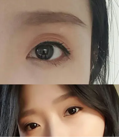 切開式目つき矯正＋目頭切開＋上眼瞼脂肪移植 6ヶ月経過レビュー