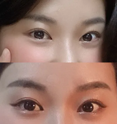 ソーセージ目再手術、目頭切開再手術、目尻切開・グラマラスライン 1年後の経過報告に来ました