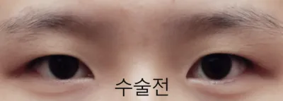 切開式目つき矯正+目頭切開・目尻切開・タレ目形成の正直レビュー!!