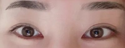 切開眼瞼下垂矯正、目頭切開して2ヶ月経ちました