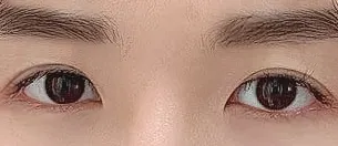 3年悩んだハム目から脱出！最初からチェ院長に頼めばよかった件😭