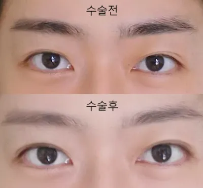 埋没レポ📝 うっすら線 ➡ パッチリ二重にアプデ完了 DT短すぎて神