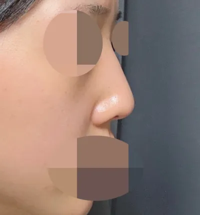 鼻中隔矯正術＋下鼻甲介切除術で機能性鼻整形を受けました！