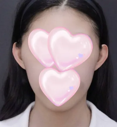 自腹で頬骨縮小、顎先縮小、顎先前進術をしました〜