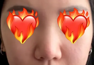 団子鼻が悩みだったので、ベリーグッドで鼻整形をしました。