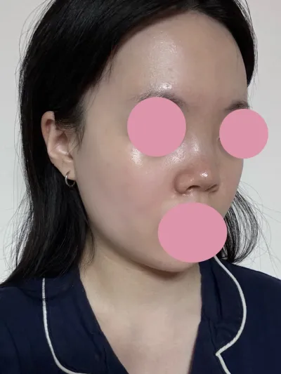 もともと短くて低い鼻でしたが、しっかり変化がありつつも自然に仕上がって満足しています :)