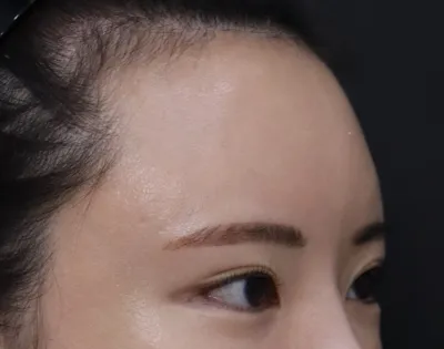手術当日は少し痛みましたが、効果があってとても良かったです！目と眉の間も広くなって、おでこは狭くなりました〜^^