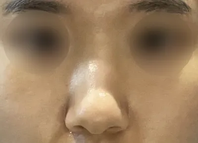 手術から2ヶ月が経った今、とても満足していますし、副作用も全くなくて元気に過ごしています。