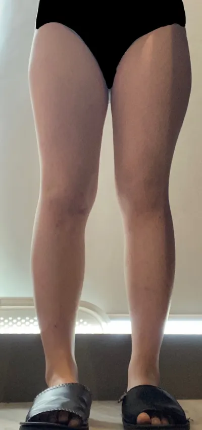 本当にたくさんのダイエットを試してきましたが、毎回太もものお肉だけが落ちなくて、すごくストレスだったんです。脂肪吸引が正解です。