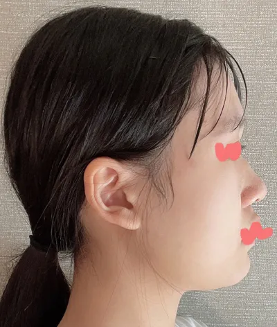 とても満足していますし、自己肯定感もぐんと上がりました。鼻の整形を悩んでいる方は、もうやってしまったほうがいいと思います。