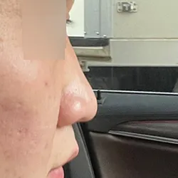 低い鼻と広い鼻がコンプレックスでしたが、ひとまず術後の経過時間のわりに、すでに満足しています。