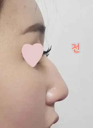 周りからも鼻が綺麗になったねってみんな褒めてくれました。