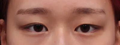 院内も清潔で皆さん親切だったので、カウンセリングから手術、アフターケアまで負担なく受けられたと思います。