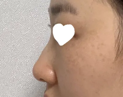 鼻炎の手術をするついでに、わし鼻を整えて鼻の手術も一緒に受けることになりました。