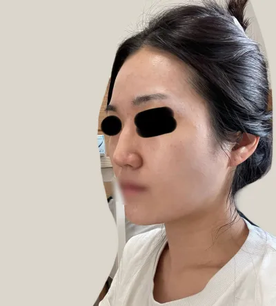 施術5ヶ月目です。