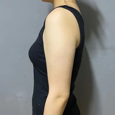 二の腕脂肪吸引半年経過レポ！