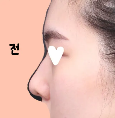 ベリーグッド整形外科で鼻整形（初めての鼻）の手術をしてから、もう2週間目です！