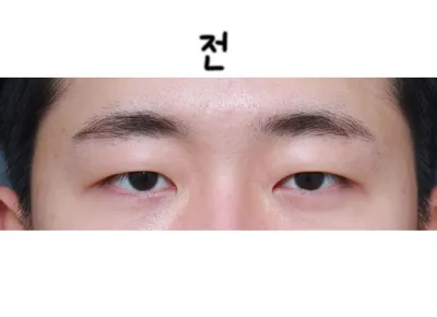 パク・サンウク院長先生に手術を受けてから5ヶ月ほど経ちましたね。