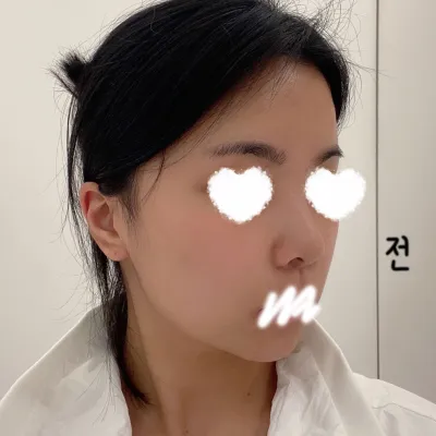 ベリーグッド美容外科で受けて5ヶ月経ちましたｗｗ