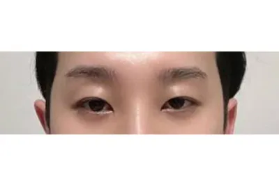 手術6ヶ月目のレビューです。