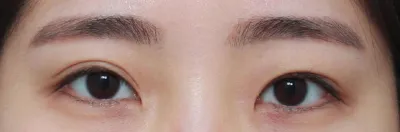 目整形（目の再手術）3ヶ月目レポ、、、