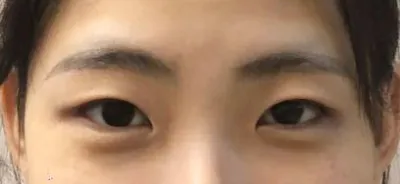今年の4月20日に、目の整形（初めて）で二重（自然癒着法）と目つき矯正（非切開法）による二重手術を受けました。