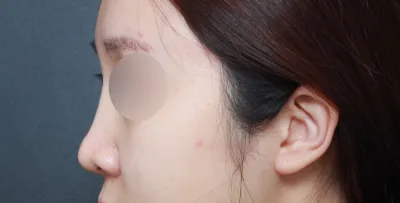 鼻の再手術を探し回っていたのがつい昨日のことのようなのに、もうあっという間に時間が過ぎて6ヶ月ほどになりますね。