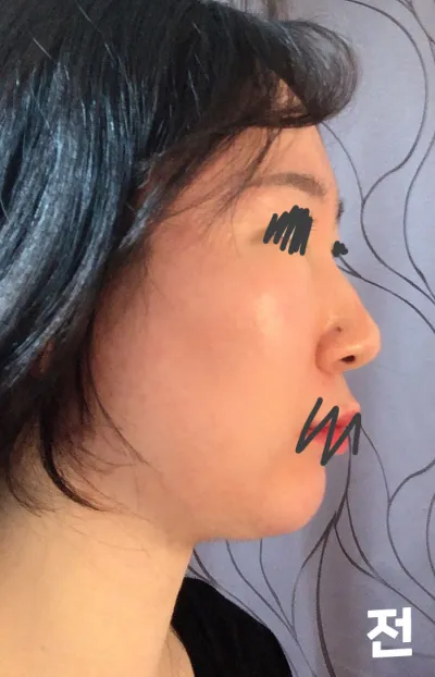 ベリーグッド美容外科で隆鼻術、骨切り、下鼻甲介、鷲鼻矯正、小鼻縮小をしました。受けてからもう7ヶ月ほど経ちましたね！