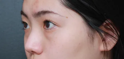 ベリーグッド美容外科で鼻整形（初鼻）、隆鼻術、骨切り、目の下の脂肪再配置を受けました！