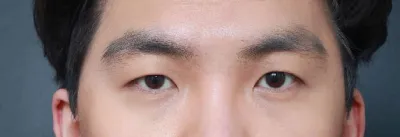 メンズ目元整形、やっと自信がつきました（笑）