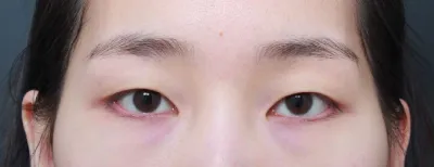 ずっと前から手術するか悩んでいましたが、受けて本当によかったです！