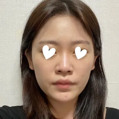 鼻の手術ひとつでイメチェンできて、気分がいいです ❤️