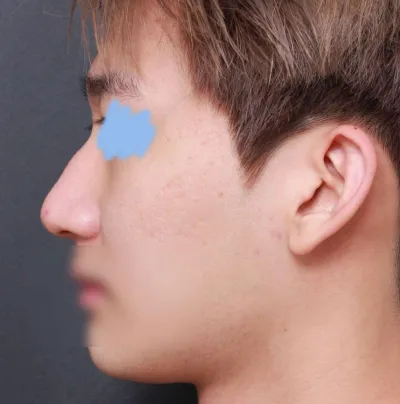 ベリーグッド美容外科で鼻の手術を受けてから1ヶ月目のレビューです！