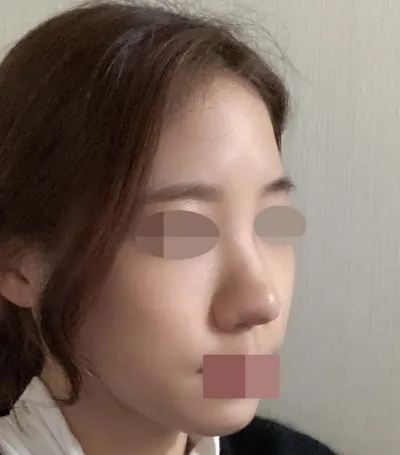 鼻フィラーだけ受けている方や鼻の手術を悩んでいる方は、ぜひ悩まずに手術をおすすめします！イム院長、本当に本当におすすめです！！