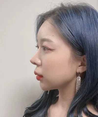 ベリーグッドでの鷲鼻矯正9ヶ月目レポ！