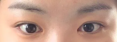 ベリーグッドは二重整形の有名店なので、悩んでいる方はぜひ早めに訪問してみてくださいね〜！