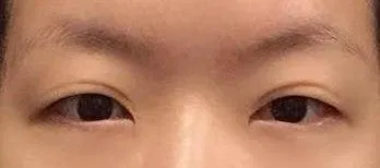 こんにちは。もう手術してから6ヶ月経ちましたね。