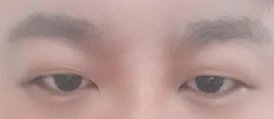 非切開目つき矯正手術をしました。