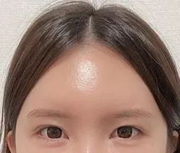 額挙上術4ヶ月後のレビューです~~